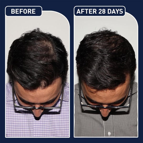 البخاخ الامريكي لنمو الشعر FEG